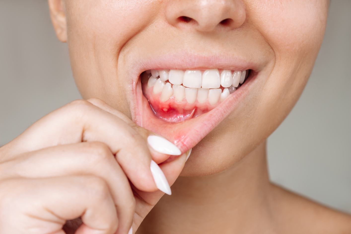 Close-up of teeth with bleeding gums, early sign of gum disease