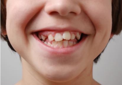 Close-up of a child with crooked teeth showing dental crowding and misaligned teeth.