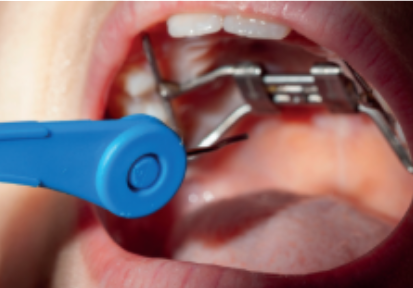 Close-up of a child wearing a traditional Hyrax palatal expander to widen a narrow upper jaw.